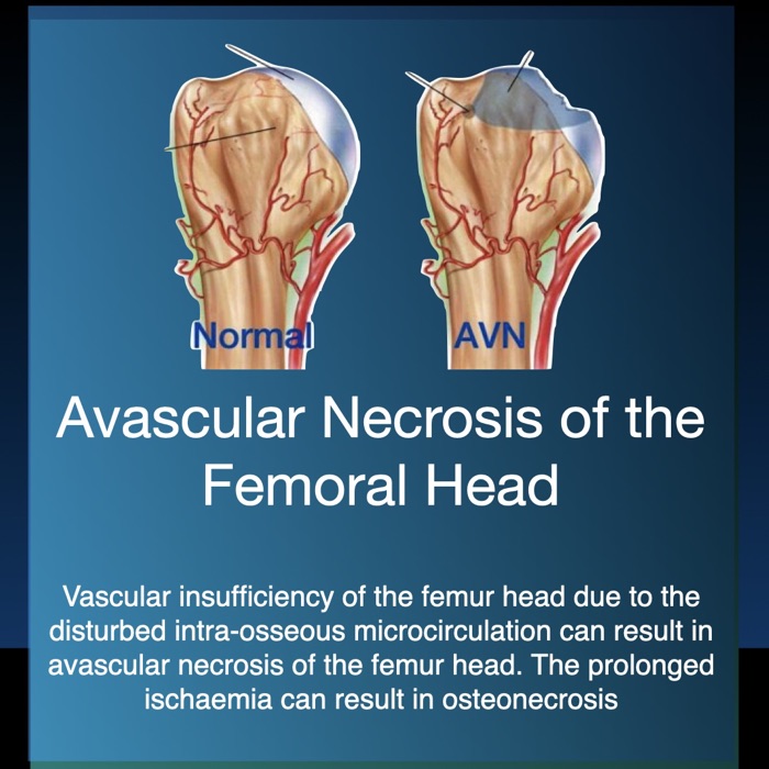 Avascular Necrosis
