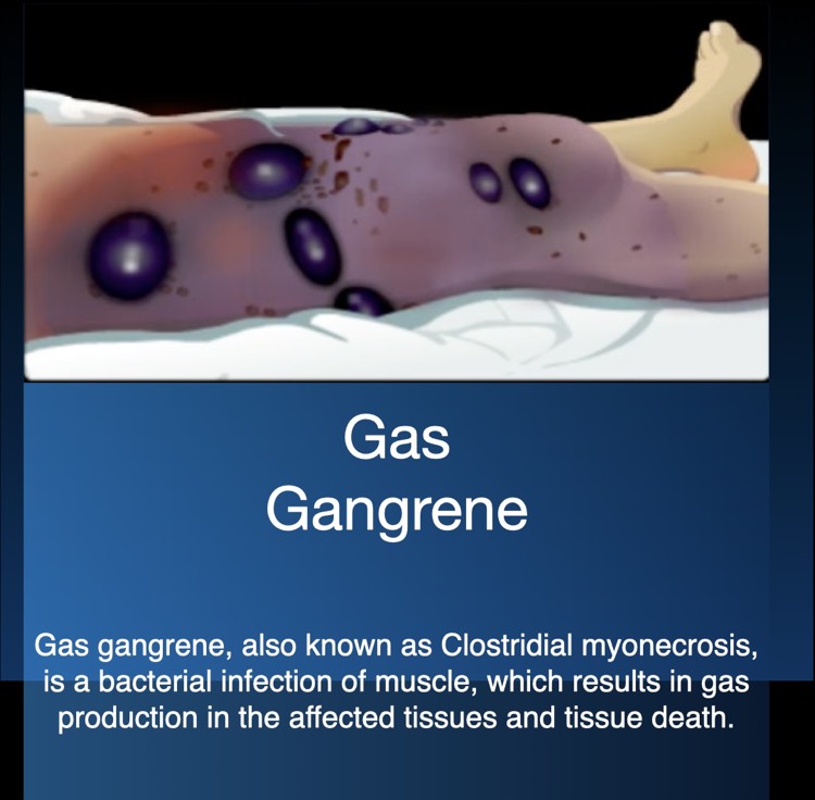 Gas Gangrene