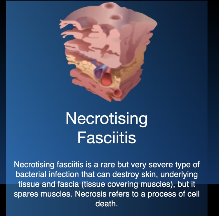 Necrotising Fasciitis