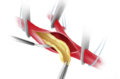 Carotid Endarterectomy